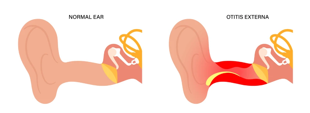 swimmer's ear inflammation