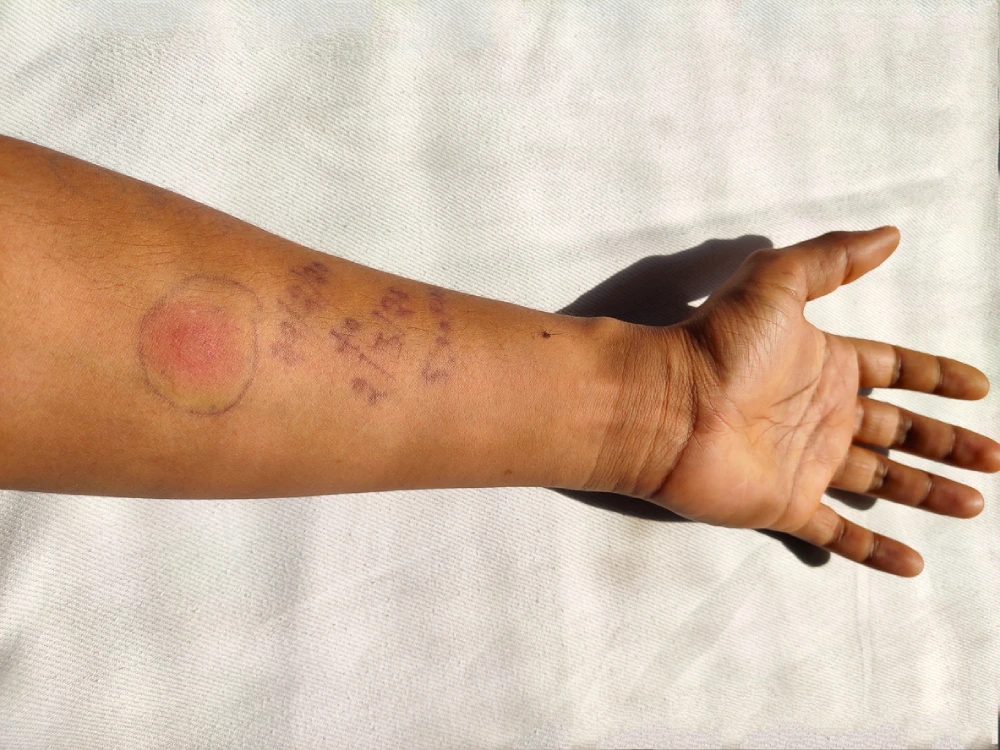 rash from a tick bite on darker skin