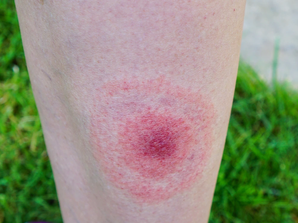 bullseye rash from a tick bite on light skin