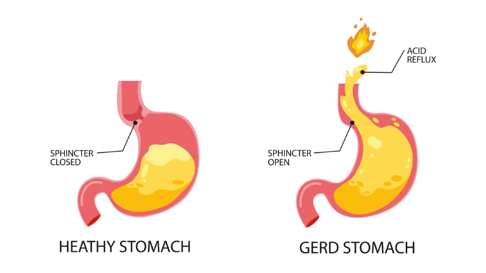 acid reflux symptoms