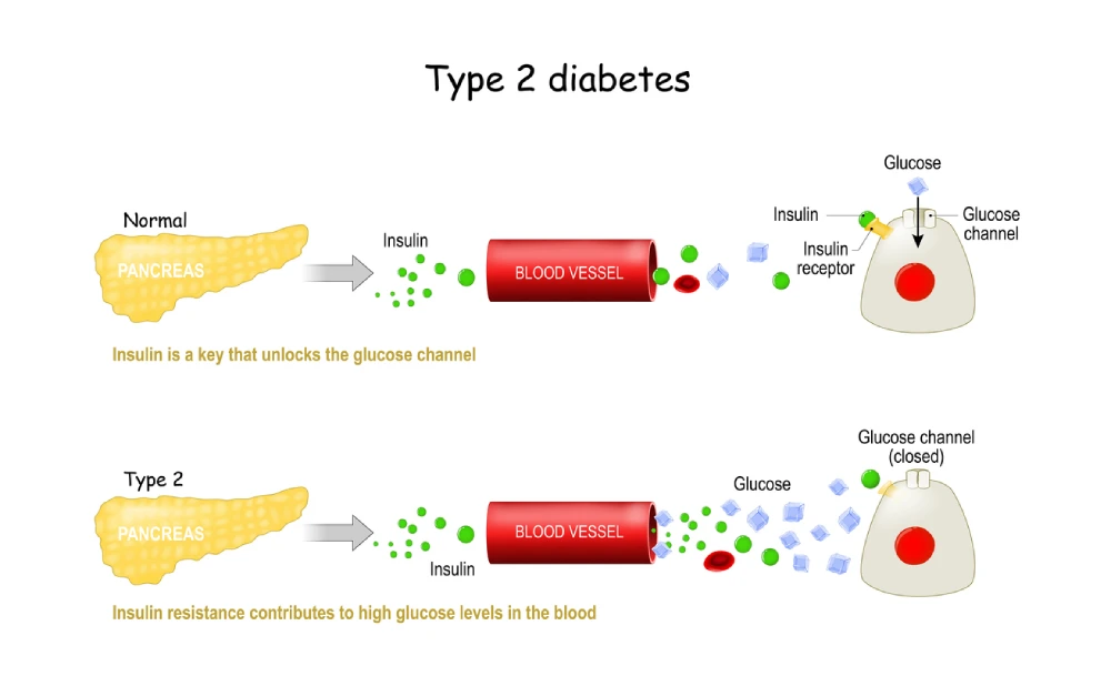 type 2 diabetes Infographic