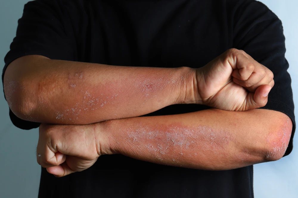 eczema rash on darker skin