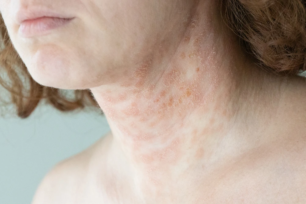 eczema rash on light skin