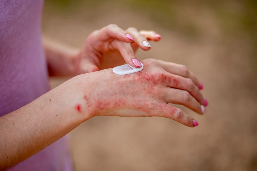 woman putting cream on an eczema rash on her hand