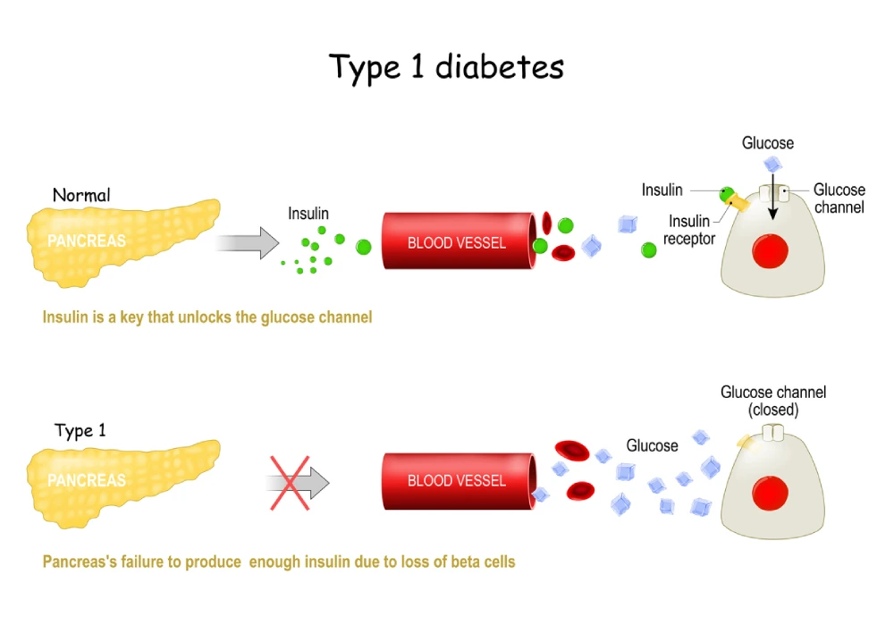 type 1 diabetes Infographic
