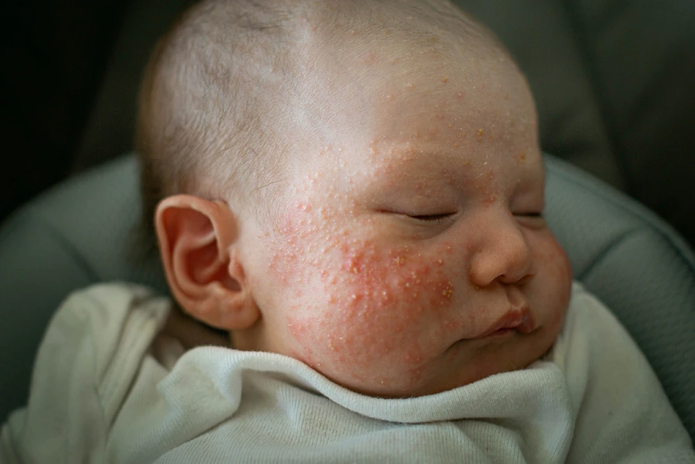 eczema rash on a baby's face