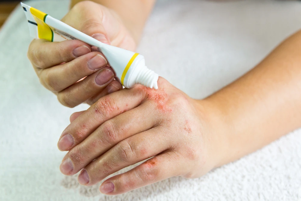 someone putting prescription topical cream on an eczema rash