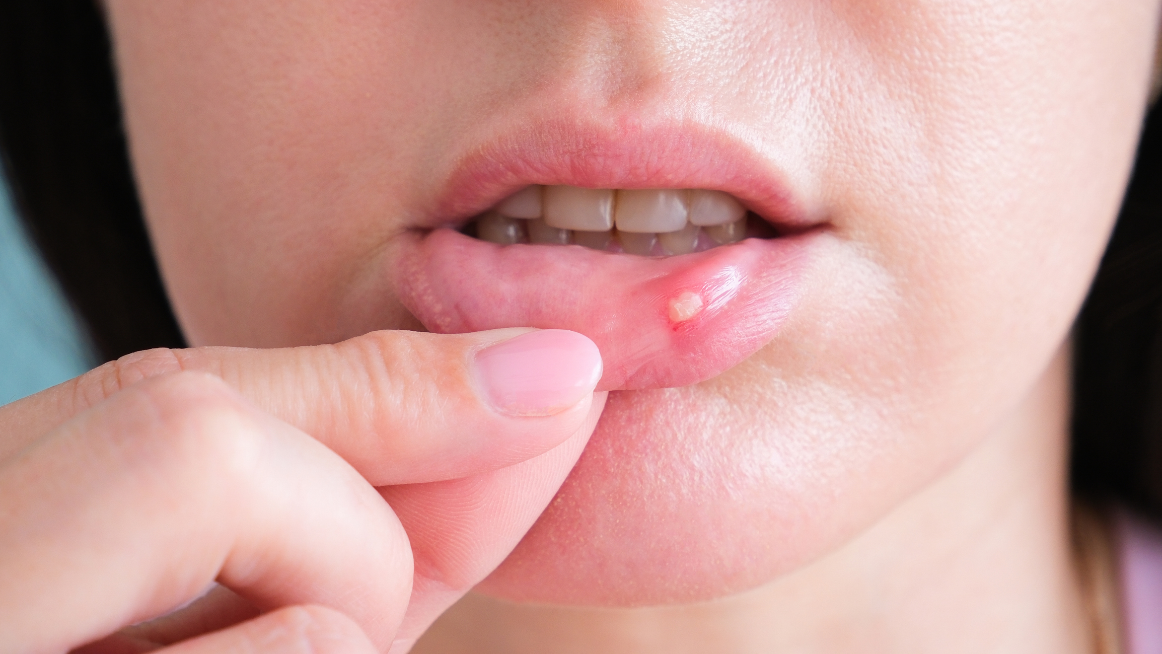 A woman pulls her lower lip to show a canker sore.